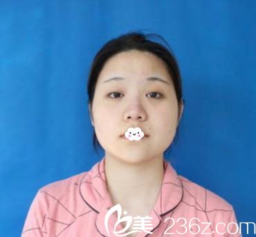 鼻子宽想补救找武汉壹加壹付俊俐做鼻综合案例 鼻子宽想补救找武汉壹加壹付俊俐做鼻综合案例