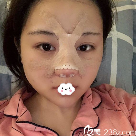 武汉壹加壹付俊俐假体+耳软骨隆鼻案例术后效果 武汉壹加壹付俊俐假体+耳软骨隆鼻案例术后效果