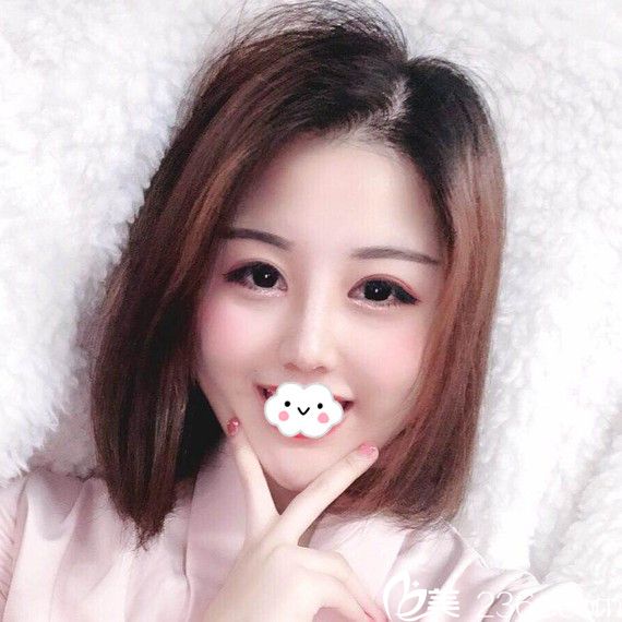 武汉隆鼻哪家医院好?武汉壹加壹鼻综合案例 武汉隆鼻哪家医院好?武汉壹加壹鼻综合案例