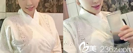 做完假体隆胸7天拆线效果图