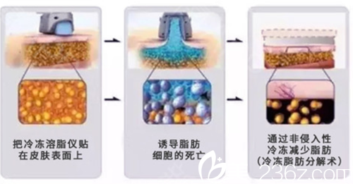 日本加藤clinic麻布医院冷冻溶脂示意图