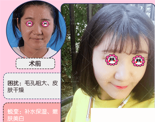 北京美莱2019年1月特惠价格表公布！小气泡38元，无针99元