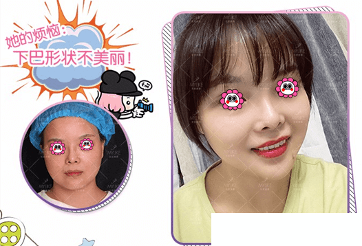 北京美莱小V脸案例 北京美莱小V脸案例