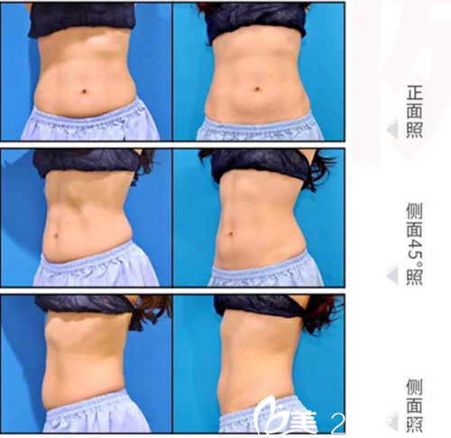 日本加藤clinic麻布医院冷冻溶脂案例 日本加藤clinic麻布医院冷冻溶脂案例