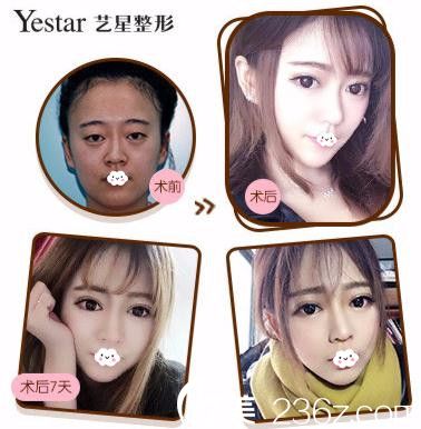 武汉艺星双眼皮案例效果对比图 武汉艺星双眼皮案例效果对比图