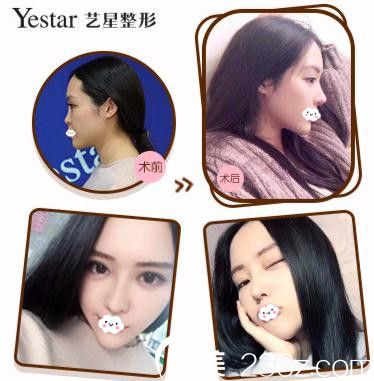 武汉Yestar艺星杨国梁假体鼻综合案例对比效果 武汉Yestar艺星杨国梁假体鼻综合案例对比效果