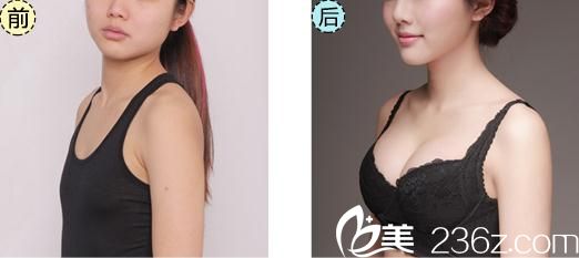 武汉艺星徐国建假体隆胸案例前后对比图 武汉艺星徐国建假体隆胸案例前后对比图