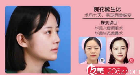 柳州华美整形双眼皮+鼻综合案例效果图