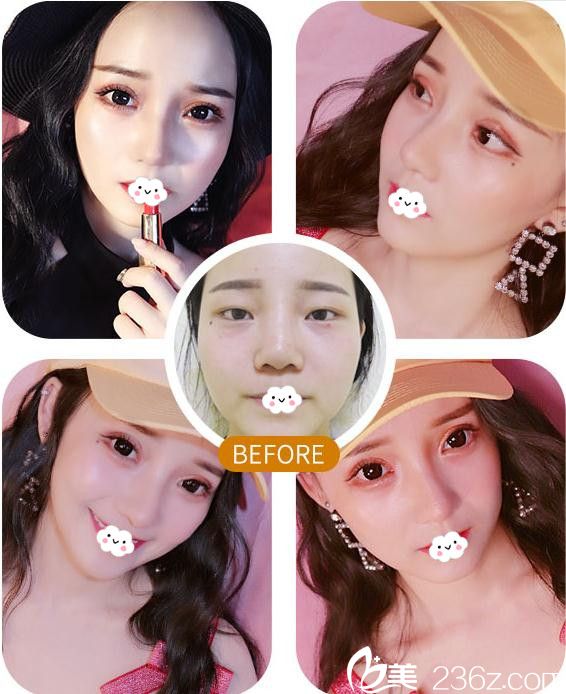 武汉美立方胡江伟院长双眼皮修复案例