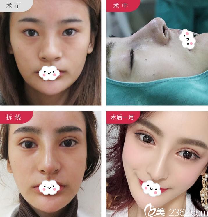 武汉美立方胡江伟鼻综合隆鼻恢复图