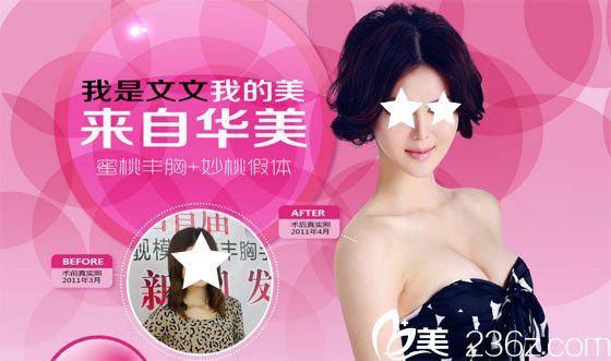 柳州华美整形假体隆胸术前术后对比图