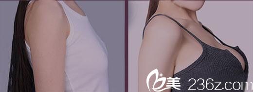 武汉美立方胡文亚假体隆胸案例