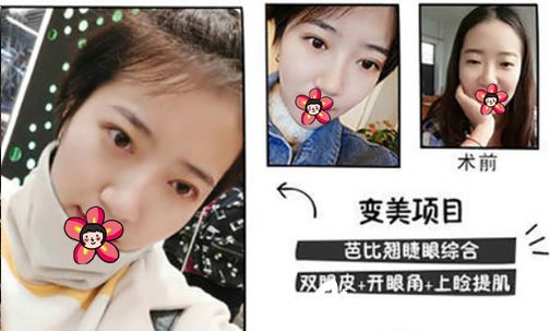 湖州尚丽芭比翘睫眼综合案例 湖州尚丽芭比翘睫眼综合案例