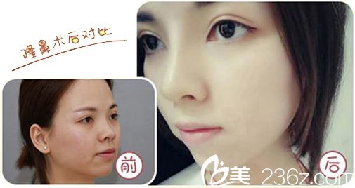 湖州尚丽假体隆鼻真人案例 湖州尚丽假体隆鼻真人案例