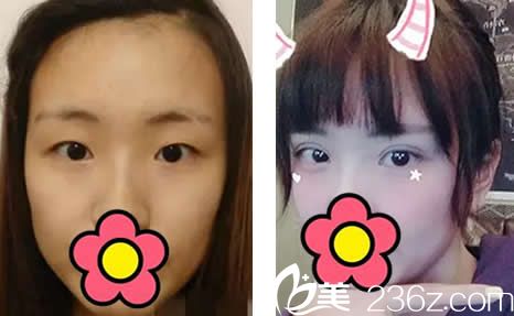 看了我在整形割双眼皮+开眼角一个月的效果后 朋友都说这样的价格太值了