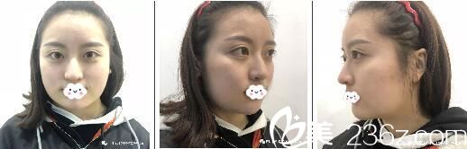 手术前肉肉的大圆脸 手术前肉肉的大圆脸