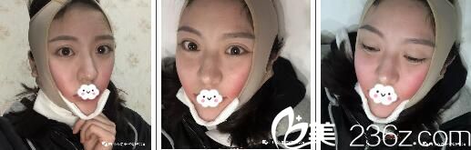 刚做完面部吸脂戴的头套 刚做完面部吸脂戴的头套