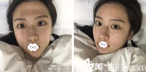 面部吸脂7天后效果 面部吸脂7天后效果