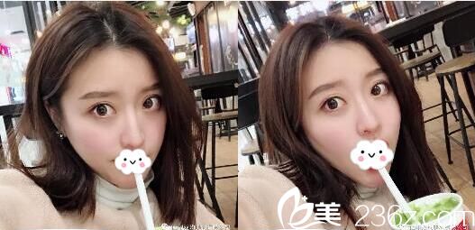 面部吸脂手术半个月恢复照片 面部吸脂手术半个月恢复照片