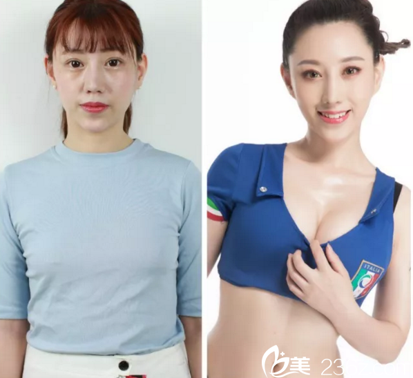 <!--<i data=20240703-sp></li>
<li><i data=20240703-sp></i>-->隆胸真人案例