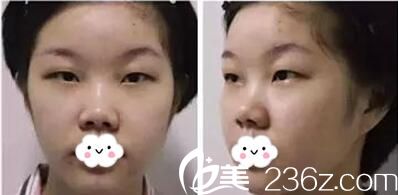 双眼皮玻尿酸隆鼻术前照片 双眼皮玻尿酸隆鼻术前照片
