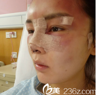 深圳美莱隆鼻修复术后照片
