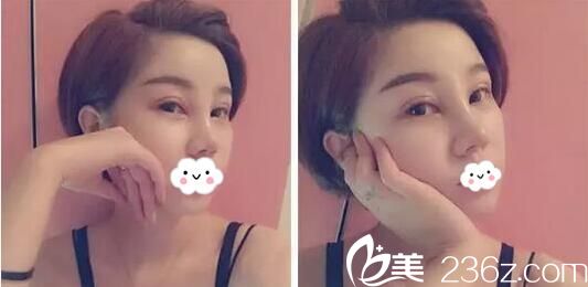 玻尿酸隆鼻术后11天效果 玻尿酸隆鼻术后11天效果