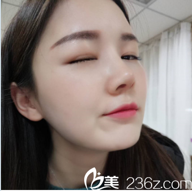 深圳美莱梁晓健隆鼻修复案例