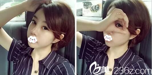 切开双眼皮+玻尿酸隆鼻术后一个月照片 切开双眼皮+玻尿酸隆鼻术后一个月照片