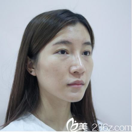 广州美莱脂肪填充案例术前照片 广州美莱脂肪填充案例术前照片