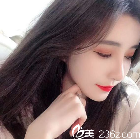 广州美莱脂肪填充案例7天效果 广州美莱脂肪填充案例7天效果