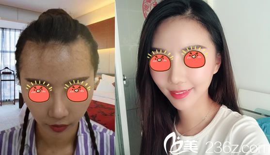 杭州连天美姚宝林种植发际线案例