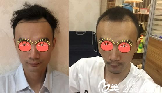 姚宝林给男士种植发际线案例