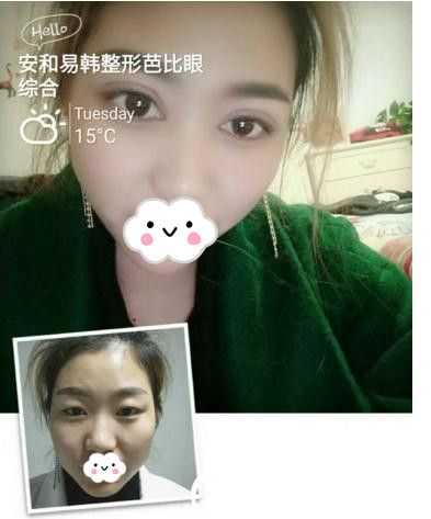 何黎院长芭比双眼皮案例 何黎院长芭比双眼皮案例