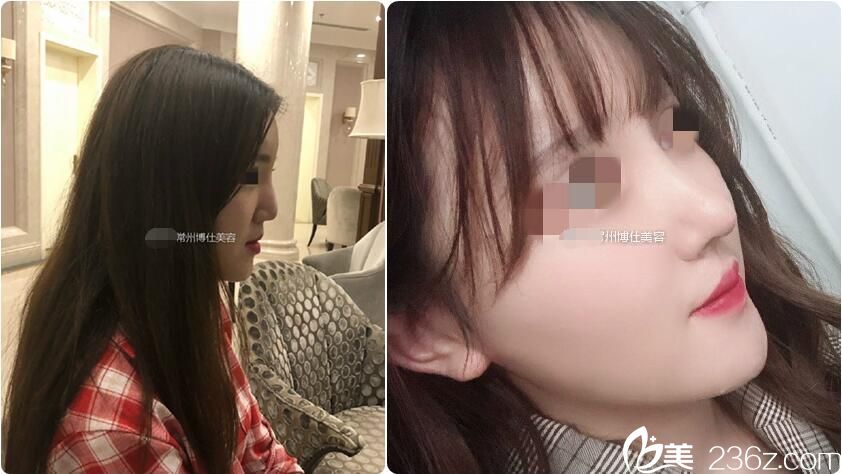 到常州博仕做肋软骨鼻综合修复手术 到常州博仕做肋软骨鼻综合修复手术