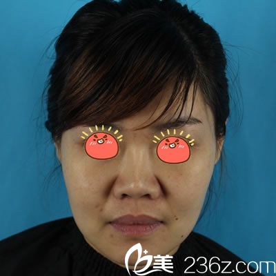 在宁波雅韩做鼻综合隆鼻前 在宁波雅韩做鼻综合隆鼻前