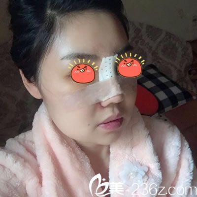 在宁波雅韩刚做完隆鼻手术照片 在宁波雅韩刚做完隆鼻手术照片