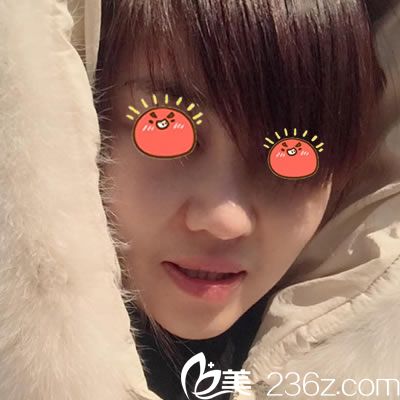 选择宁波雅韩做隆鼻7天效果对比图 选择宁波雅韩做隆鼻7天效果对比图