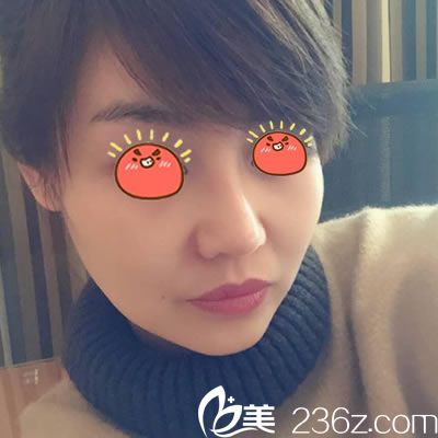 宁波雅韩龚涛隆鼻案例30天效果 宁波雅韩龚涛隆鼻案例30天效果