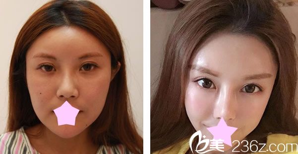台北维格整形鼻综合+耳软骨隆鼻效果对比图