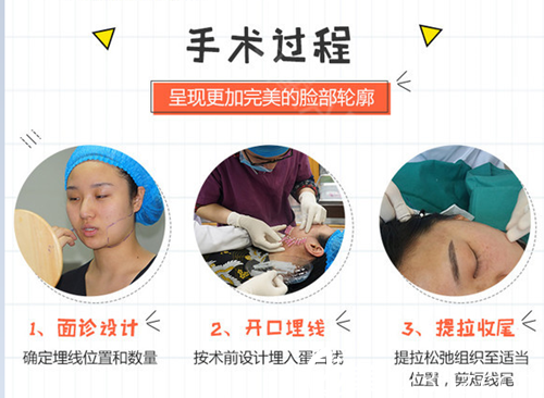 赣州星铂丽线雕手术过程