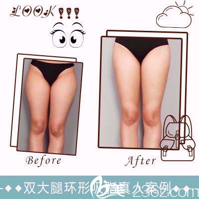 雅芳亚整形医院大腿环吸案例