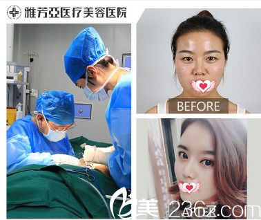雅芳亚整形医院做肋软骨隆鼻案例