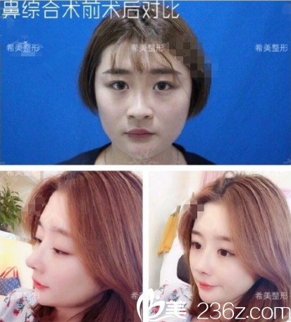 娄底希美鼻综合真人案例 娄底希美鼻综合真人案例