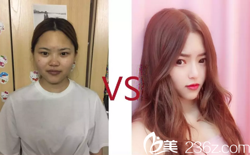 <!--<i data=20240703-sp></li>
<li><i data=20240703-sp></i>-->金平主任隆鼻案例