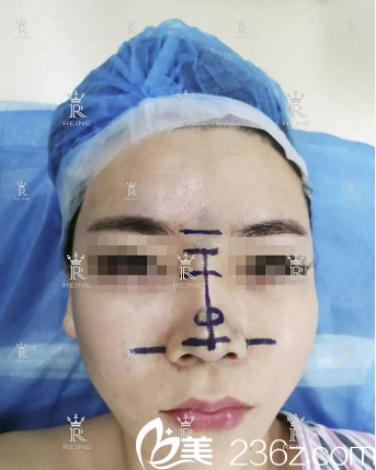 <!--<i data=20240703-sp></li>
<li><i data=20240703-sp></i>-->隆鼻案例术前照片