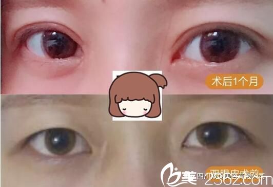 达州双均双眼皮+开眼角术后一个月对比 达州双均双眼皮+开眼角术后一个月对比