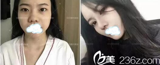 达州双开鼻综合术前术后对比 达州双开鼻综合术前术后对比