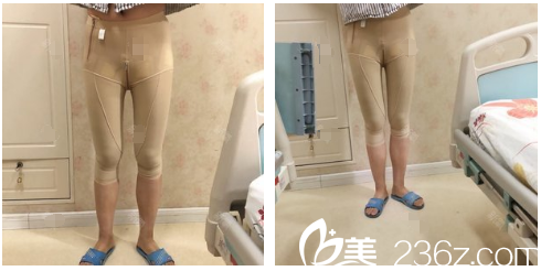 广州韩妃大腿吸脂术后三天自拍