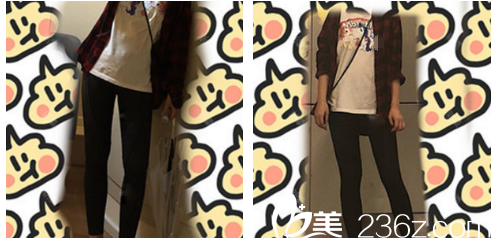 广州韩妃于洪瑞大腿吸脂术后15天 广州韩妃于洪瑞大腿吸脂术后15天